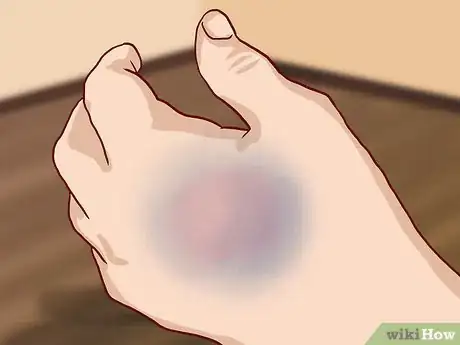Image titled Know If Your Knuckle Is Broken Step 6
