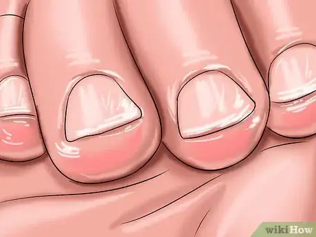 Image titled Stop Children from Biting Their Fingernails Step 15