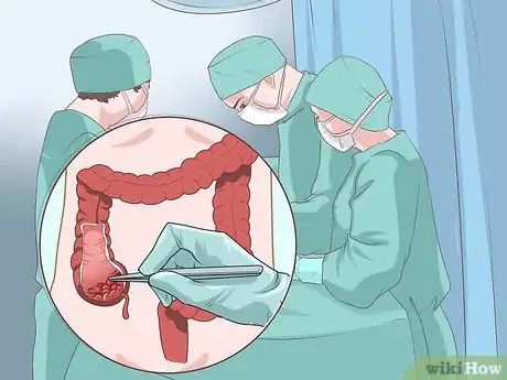 Image titled Treat Colon Cancer Step 2