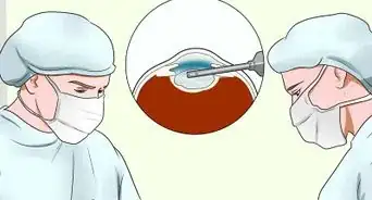 Prevent Development of Cataracts