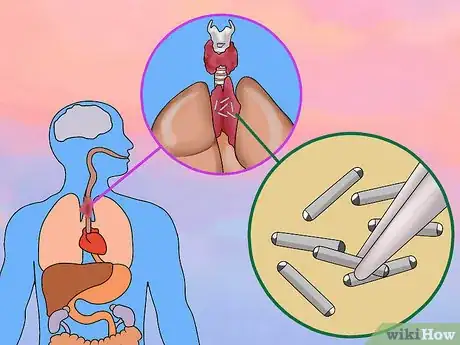 Image titled Remove a Thymoma Step 15