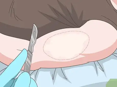 Image titled Prevent Vitiligo from Getting Worse Step 10