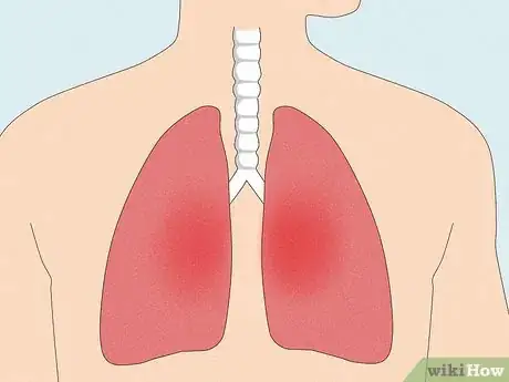 Image titled Treat Cancer with Cannabis Step 11