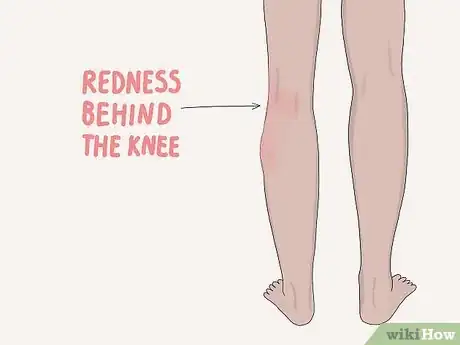 Image titled Diagnose and Treat Thrombophilia Step 3