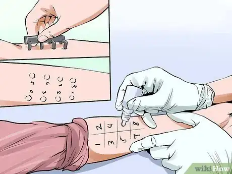 Image titled Know if You Have Eczema Step 7