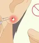 Treat Infected Piercings