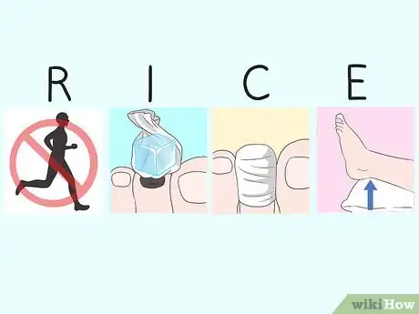 Image titled Treat a Black Toenail Step 2