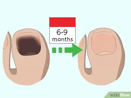Image titled Treat a Black Toenail Step 7