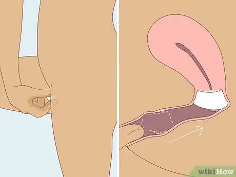 Image titled Use a Cervical Cap Step 5