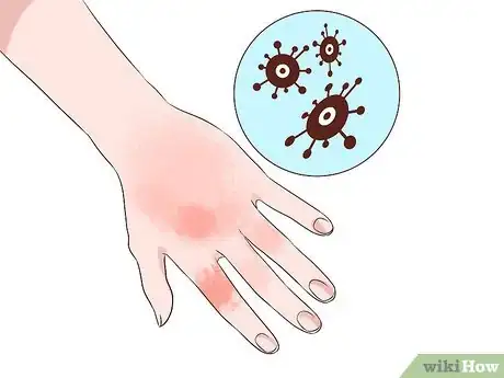 Image titled Prepare for a Kidney Biopsy Step 6