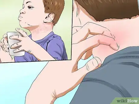 Image titled Know if You Have Eczema Step 9