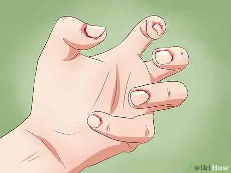 Image titled Stop Biting Your Fingers Step 11