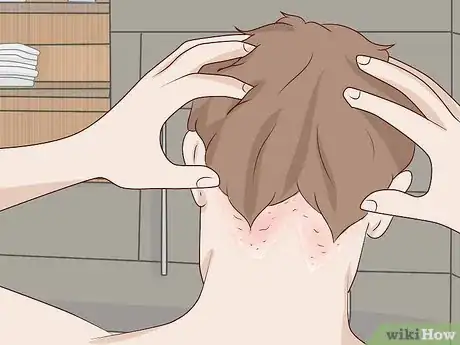 Image titled Get Rid of Dandruff at Home Step 14