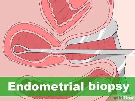 Image titled Detect Uterine Cancer Step 8
