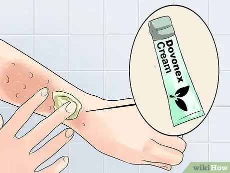 Image titled Avoid Psoriasis Vaccine Complications Step 11