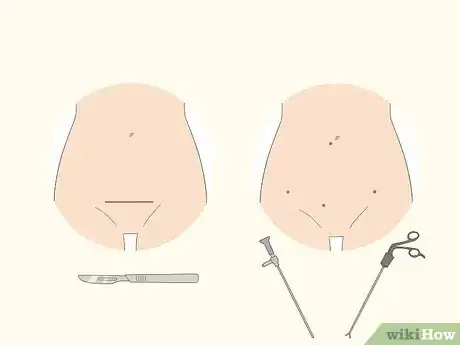 Image titled Treat Menorrhagia Step 9