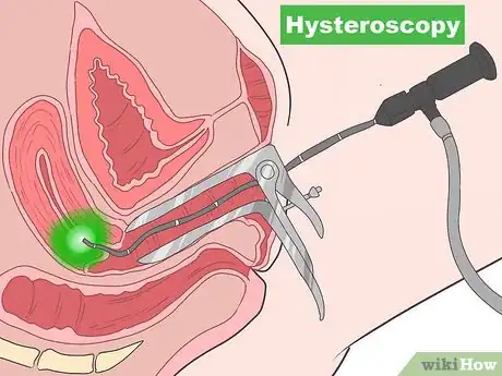 Image titled Detect Uterine Cancer Step 9