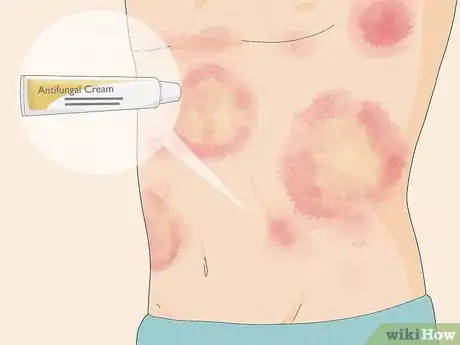 Image titled Treat Fungal Rash Step 8