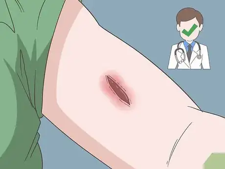 Image titled Treat Skin Picking Wounds Step 7