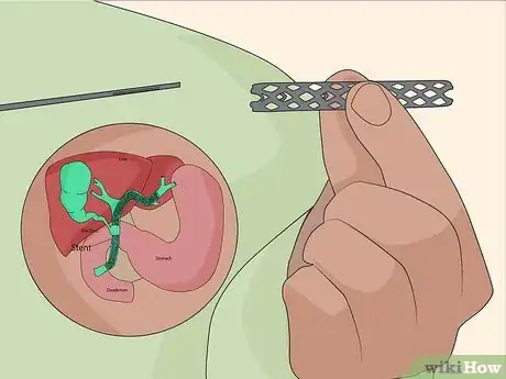 Image titled Treat Cholangitis Step 05