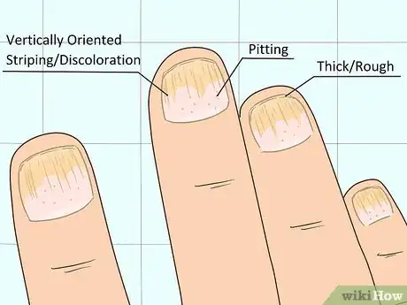 Image titled Treat Both Psoriatic Arthritis and Psoriasis Step 19
