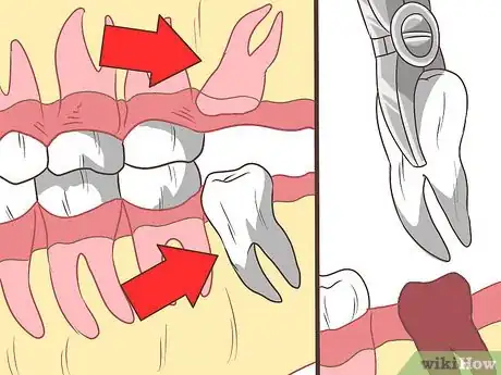 Image titled Straighten Your Teeth Without Braces Step 5