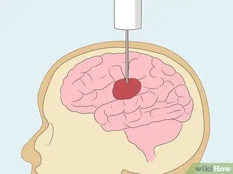 Image titled Detect Brain Cancer Step 11