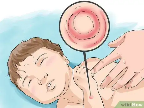 Image titled Treat Ringworm in Babies Step 1