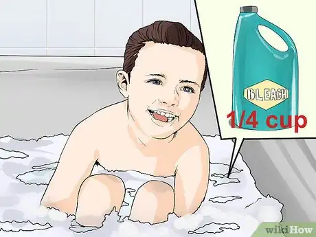 Image titled Treat Eczema in Children Step 3