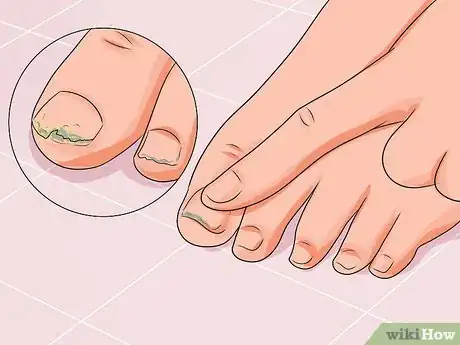 Image titled Cure Nail Fungus Step 3