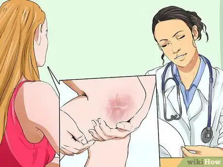 Image titled Know if You Have Eczema Step 6