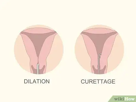 Image titled Treat Menorrhagia Step 6