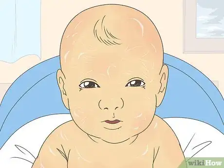 Image titled Treat Ichthyosis Step 4