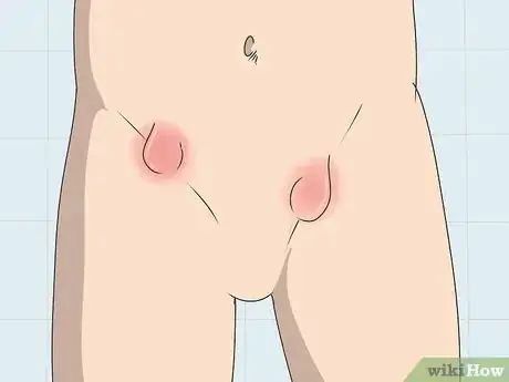 Image titled Treat Inguinal Hernia Step 1