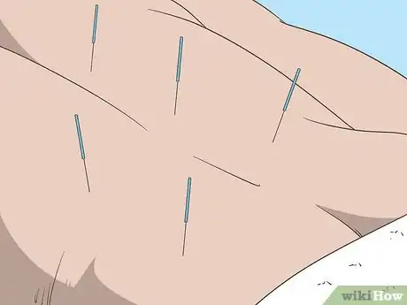 Image titled Treat Sciatica Naturally Step 12