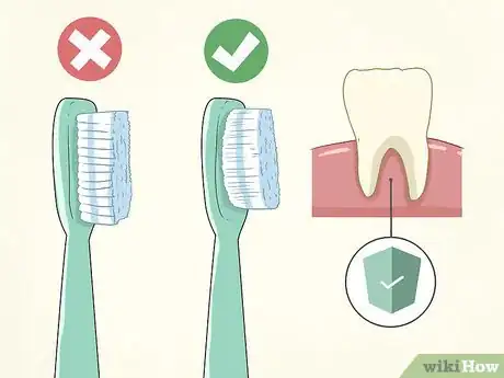 Image titled Treat Gingivitis at Home Step 3