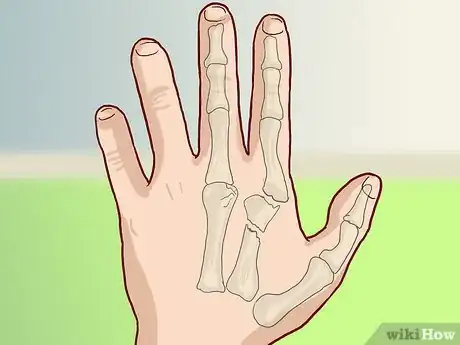 Image titled Know If Your Knuckle Is Broken Step 8
