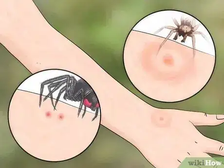 Image titled Identify Insect Bites Step 7