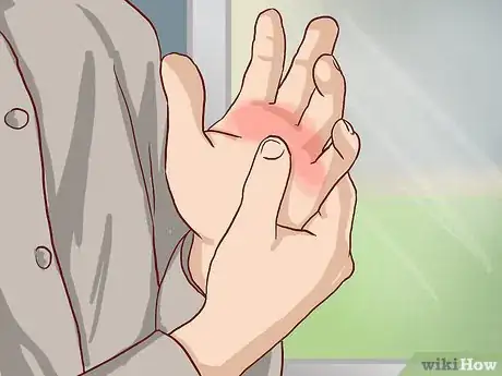 Image titled Know If Your Knuckle Is Broken Step 3