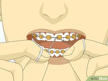 Image titled Wear Braces With Confidence and Style Step 6