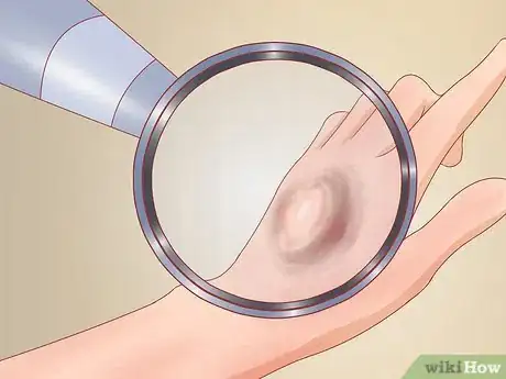 Image titled Recognize Frostbite Step 1