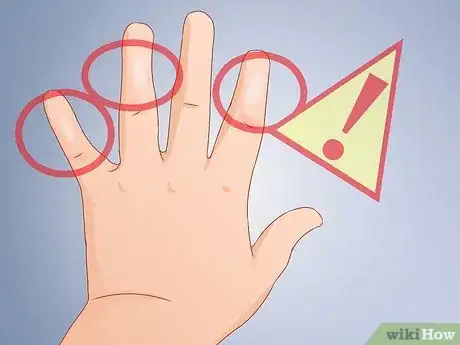 Image titled Recognize Frostbite Step 5