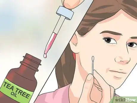 Image titled Treat Cystic Acne Naturally Step 6