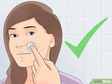 Image titled Treat Cystic Acne Naturally Step 3
