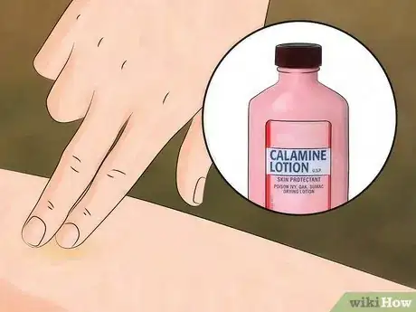 Image titled Prevent Chigger Bites Step 7