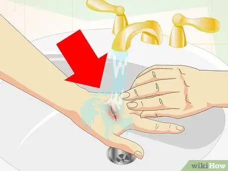 Image titled Care for Superficial Wounds Step 2