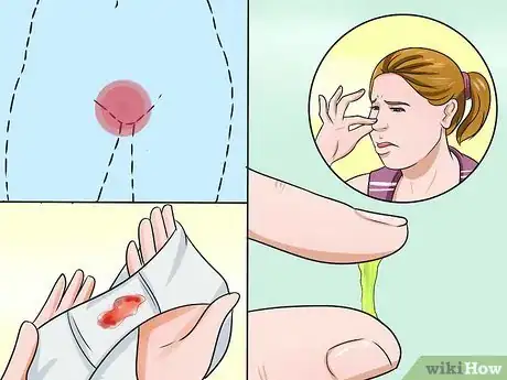 Image titled Stop Vaginal Itching Step 13