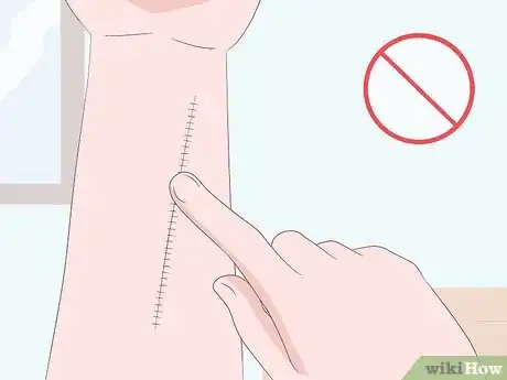 Image titled Prevent Surgical Site Infections Step 7