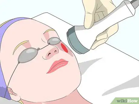 Image titled Remove Birthmarks Step 2