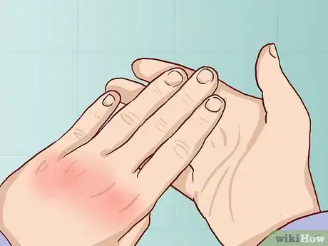 Image titled Know If Your Knuckle Is Broken Step 4